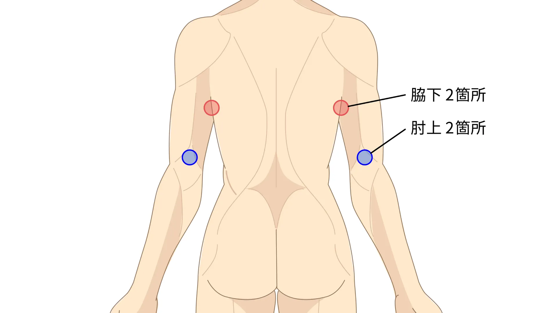 二の腕・背中の脂肪吸引の傷口の位置