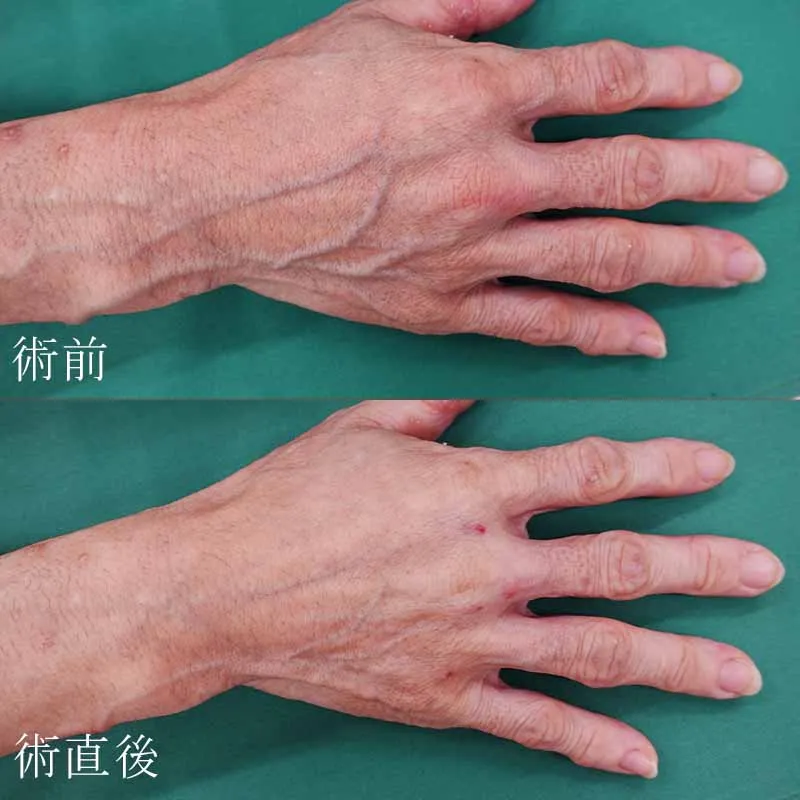 手の甲のヒアルロン酸注射の症例写真