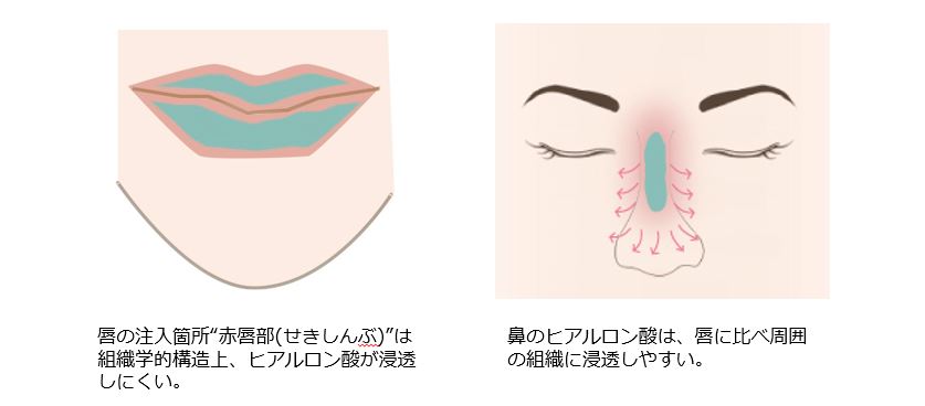 唇のヒアルロン酸と鼻のヒアルロン酸の持続期間の比較