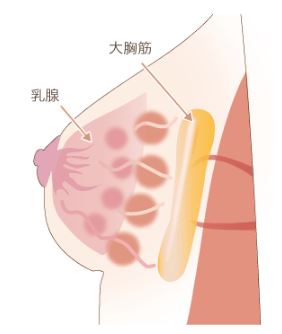 大胸筋下法と乳腺下法のイラスト