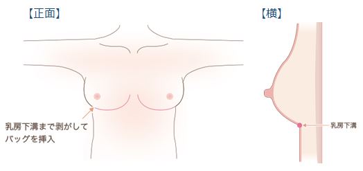 乳腺下法の手術方法