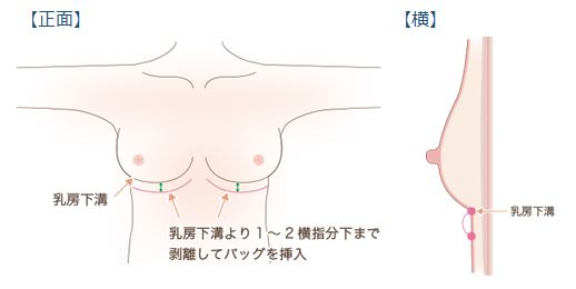 大胸筋下法の手術方法