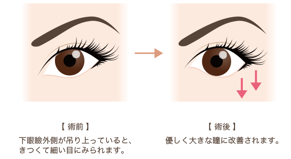 たれ目形成 グラマラスライン で効果が出ず失敗する理由 美容整形で失敗しないための秘訣 水の森美容外科