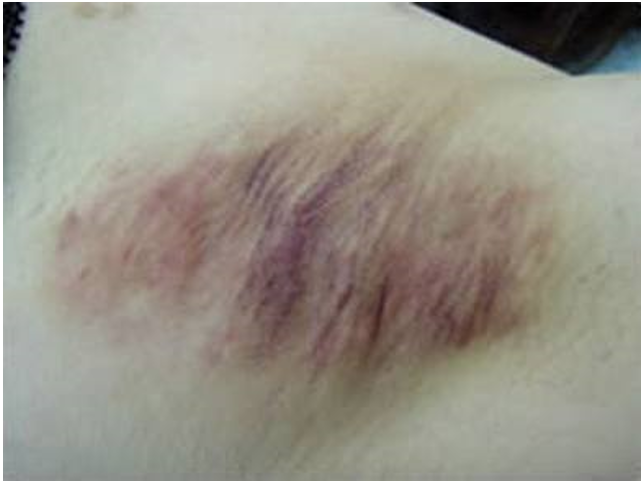 ワキガの手術後に脇の黒ずみが気になります これは治るんですか 美容整形で失敗しないために 水の森美容外科