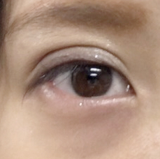 腫れぼったい二重まぶたの原因と改善策は 二重術後の失敗はやり直せる 美容整形で失敗しないための秘訣 水の森美容外科
