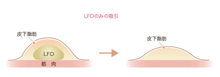LFDのみを吸引した時の図