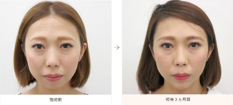 顎にヒアルロン酸 又はプロテーゼ を入れたら顎が太くなってしまいました 施術部位別の失敗談 美容整形で失敗しないための秘訣 美容整形の失敗と美容外科の裏事情 水の森美容外科 顎にヒアルロン酸 又はプロテーゼ を入れたら顎が太くなってしまいました 施術部位別の失敗談 美容整形で失敗しないための秘訣 美容整形の失敗と美容外科の裏事情 水の森美容外科