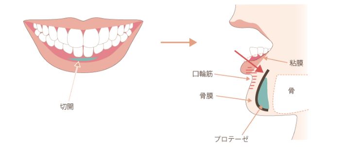 顎プロテーゼの手術方法