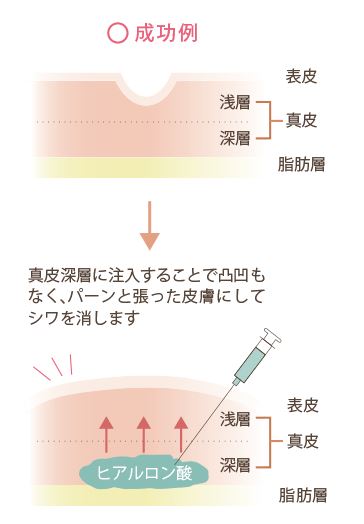 ヒアルロン酸がきちんと真皮深層に入っている例