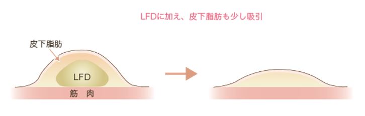 LFDに加え皮下脂肪も少し吸引した時の図