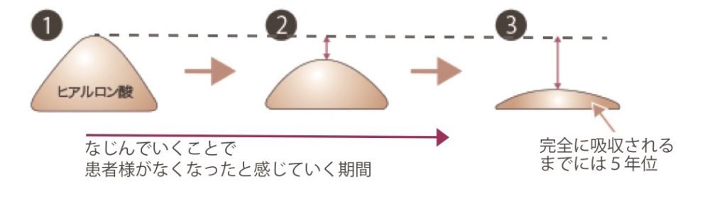 ヒアルロン酸の持続の仕組