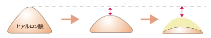 ヒアルロン酸注入後の経過