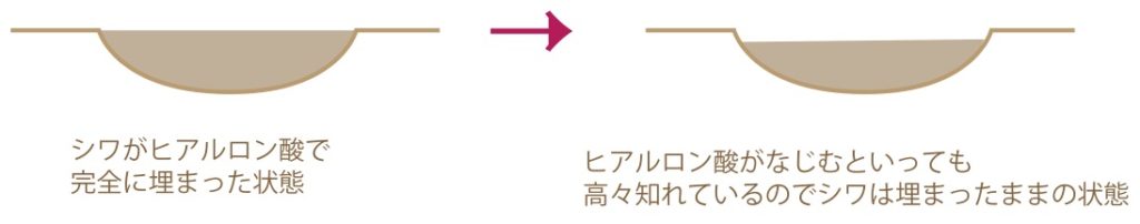 シワが深い人に注入した場合