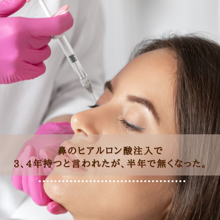鼻のヒアルロン酸注入で3、4年持つと言われたが、半年で無くなった。