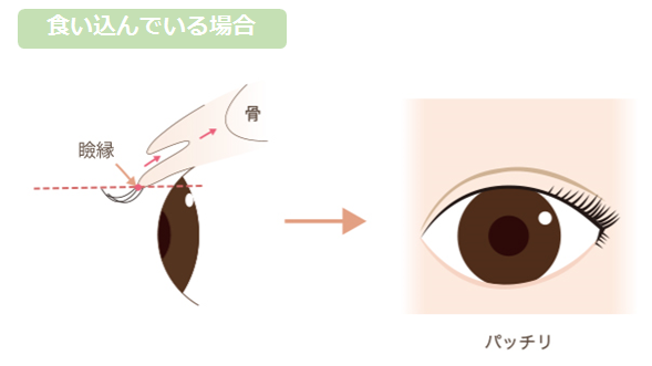 二重埋没法の施術後 幅が広すぎる眠そうな目にならないためのポイント 美容整形で失敗しないために 水の森美容外科