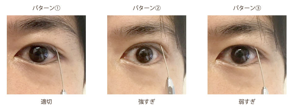二重の手術をしたが食い込みが浅い この失敗の原因は 美容整形で失敗しないための秘訣 水の森美容外科