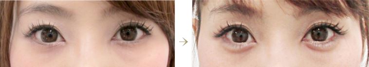 涙袋のヒアルロン酸注射 注入 の失敗事例と原因 美容整形で失敗しないために 水の森美容外科