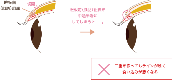 二重切開法でも取れることはあるのか 美容整形で失敗しない秘訣 水の森美容外科