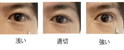 二重整形で理想の二重にならない 後悔しないためのポイント 美容整形で失敗しないために 水の森美容外科