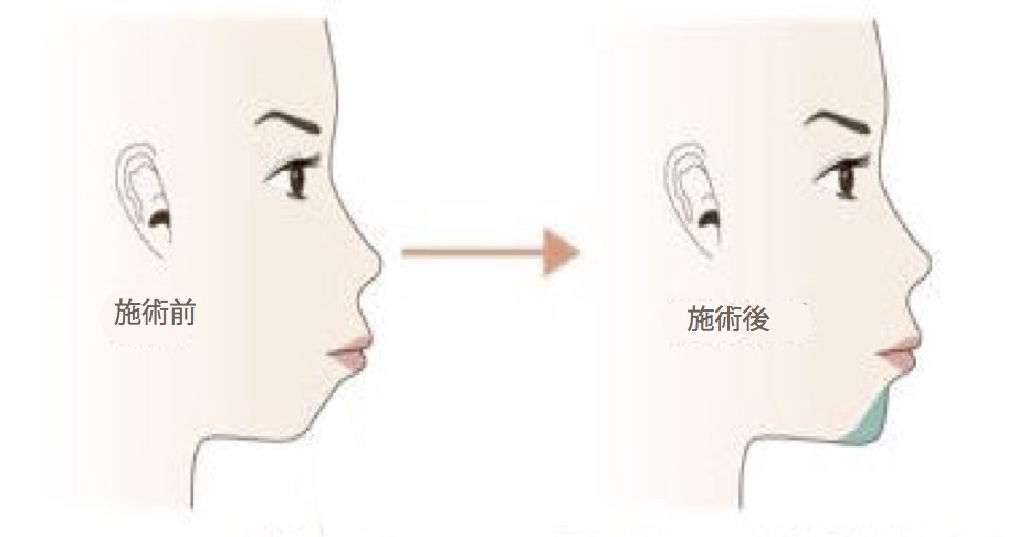 顎のプロテーゼの効果が物足りません 入れ替えは出来るのでしょうか 美容整形で失敗しないために 水の森美容外科