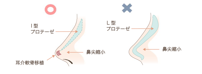 I型プロテーゼとL型プロテーゼの比較