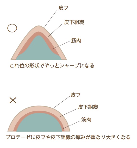 プロテーゼの形と見え方