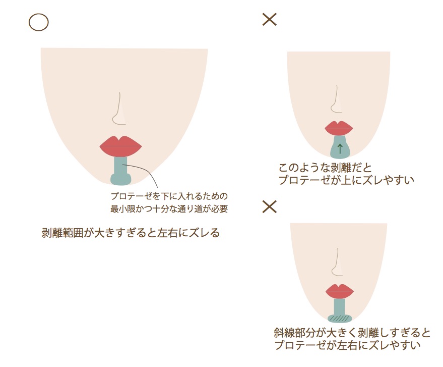 正しい剥離と誤った剥離