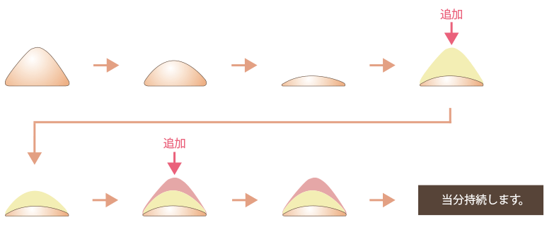 ヒアルロン酸やレディエッセを複数回注入することで蓄積され、効果は当分持続する