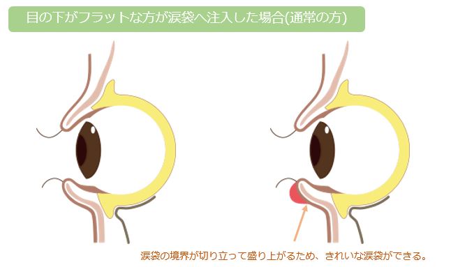 通常の方の目の下の解剖図