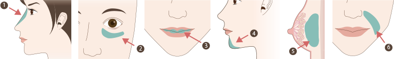ヒアルロン酸が注入できる部位