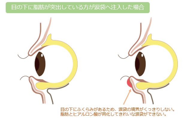 目の下の脂肪が出ている方の解剖図