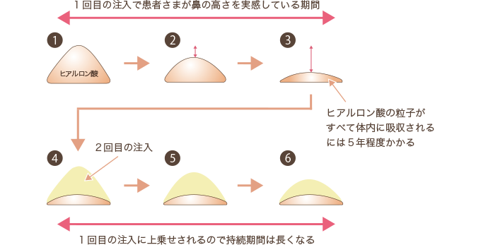 ヒアルロン酸1回目と2回目の注入
