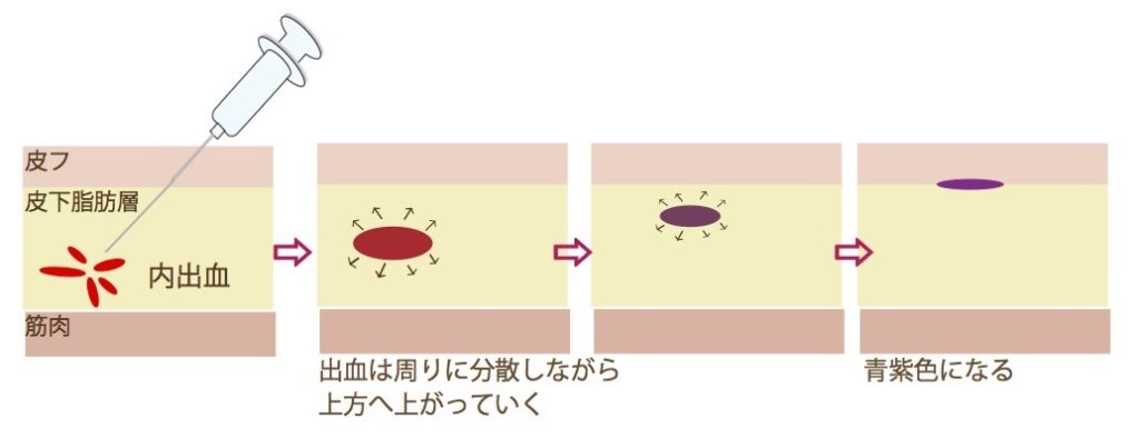 内出血の経過イラスト