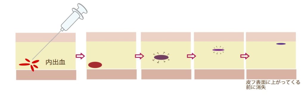 皮膚の深い部分に内出血が出たイラスト