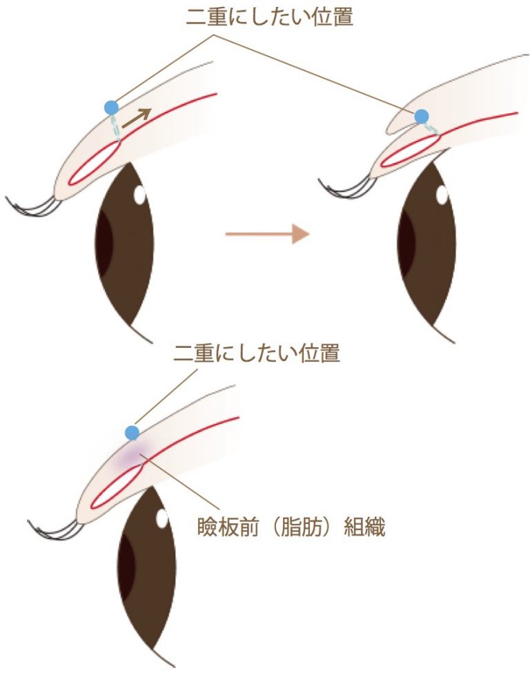 瞼板前組織