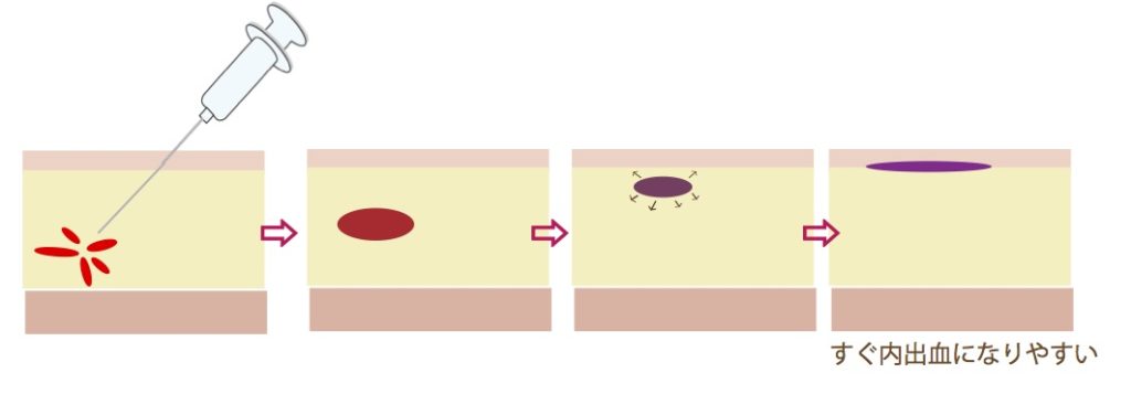 薄い皮膚の下にできた内出血