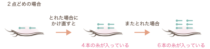 二重埋没法2点留めの場合