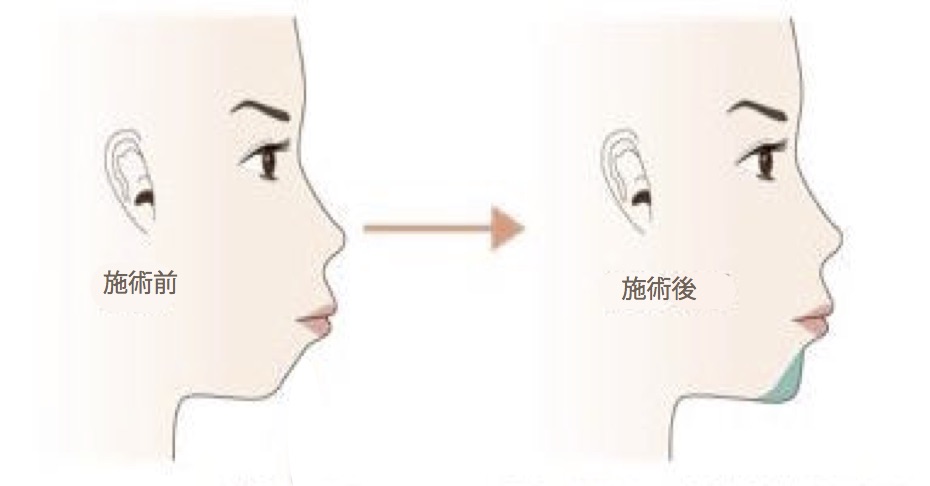 顎の施術前と施術後の横顔イメージ