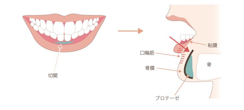 顎のプロテーゼの手術方法2