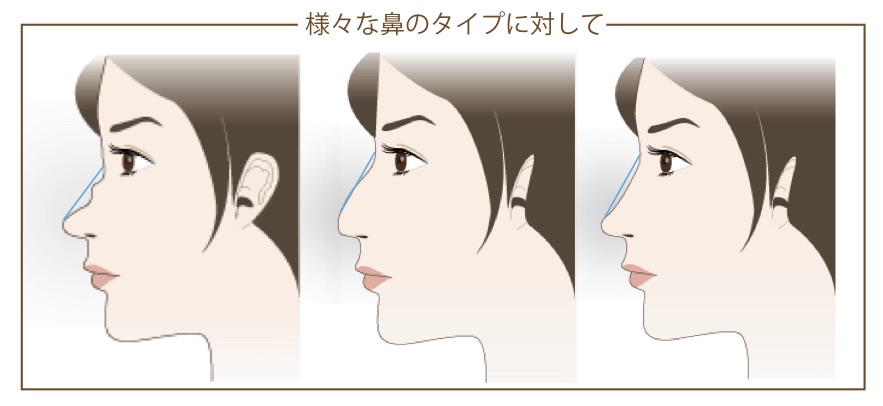 様々な鼻のタイプ