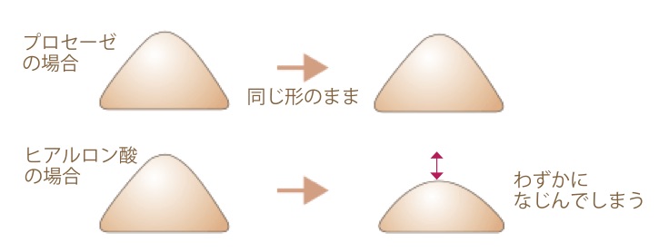 プロテーゼに比べヒアルロン酸は馴染んでしまう