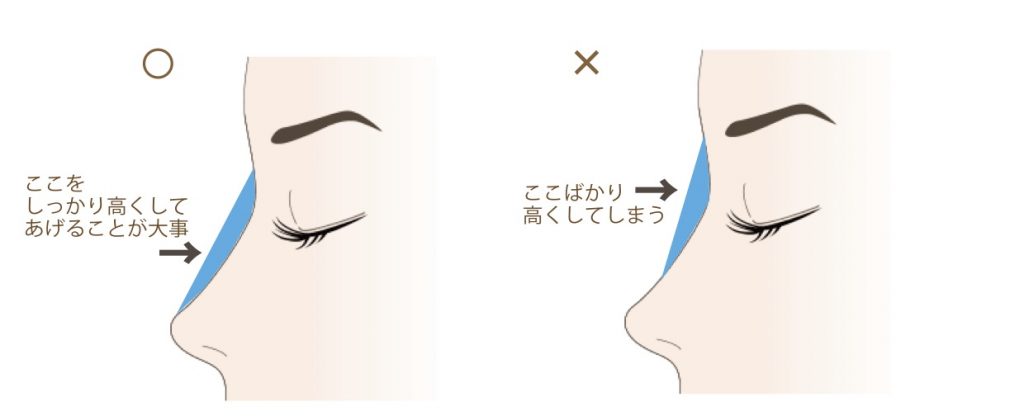 高さの足りない部分をヒアルロン酸で補っている図