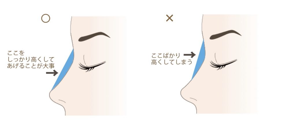 高さの足りない部分をヒアルロン酸で補っている図