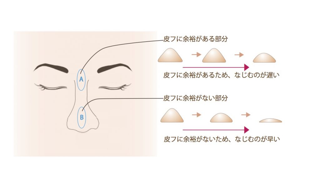 皮膚に余裕のない部分へのヒアルロン酸注入は馴染みが早い