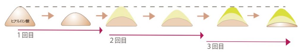 ヒアルロン酸注入を数回行うと長期間持続するようになる