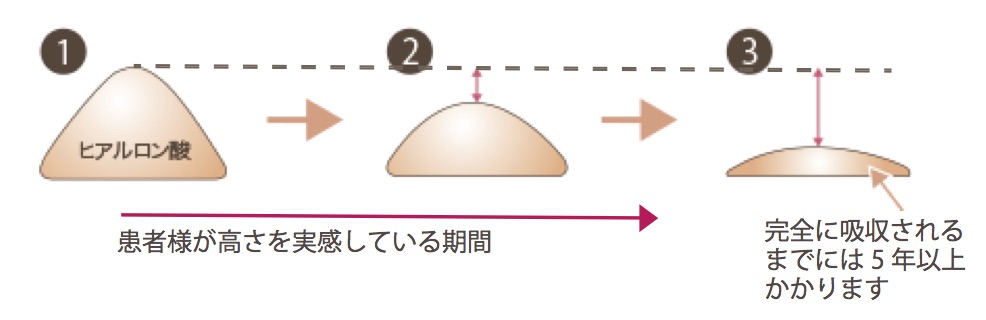 ヒアルロン酸注入後の経過