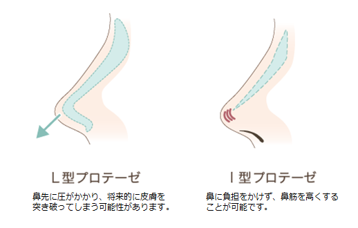 L型プロテーゼとI型プロテーゼのイラスト1