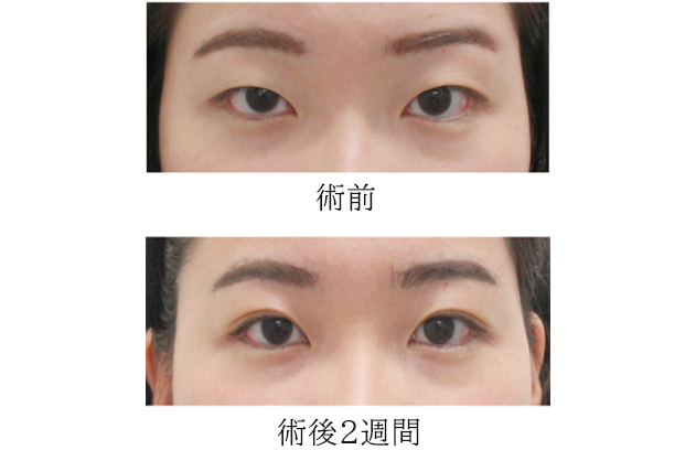 腫れぼったい二重まぶたの原因と改善策は 二重術後の失敗はやり直せる 美容整形で失敗しないための秘訣 水の森美容外科