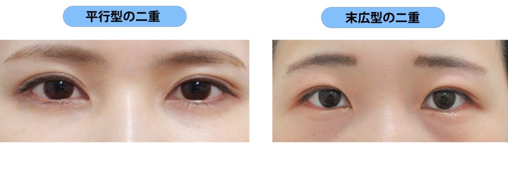 二重術後 目の開きが悪く 眠そうな目になってしまいました 美容整形で失敗しないための秘訣 水の森美容外科
