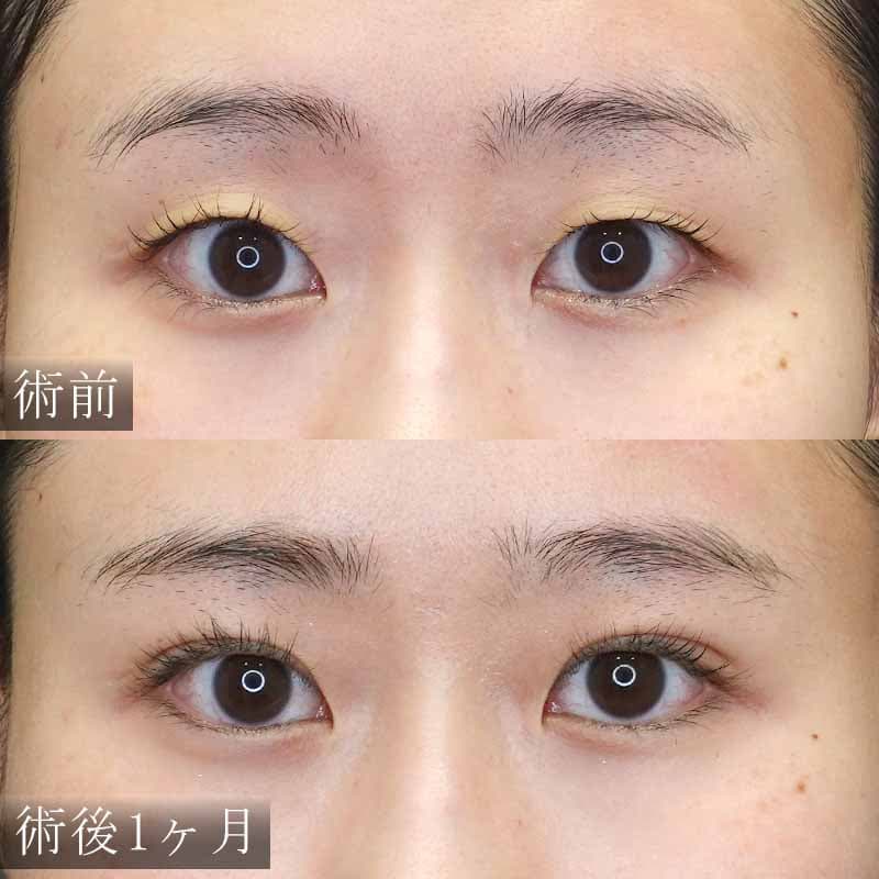 大阪心斎橋院酒井医師の自然癒着法の症例写真